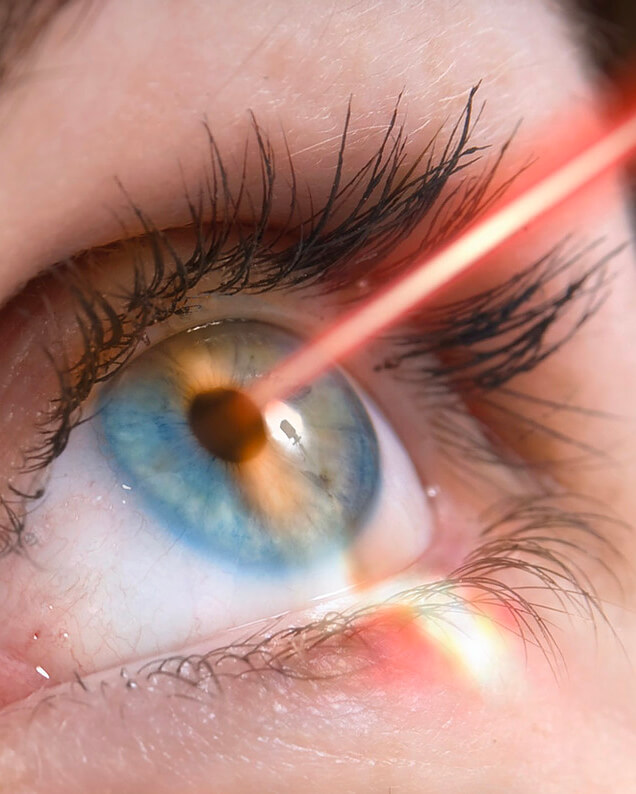 Laser Eye surgery antalya